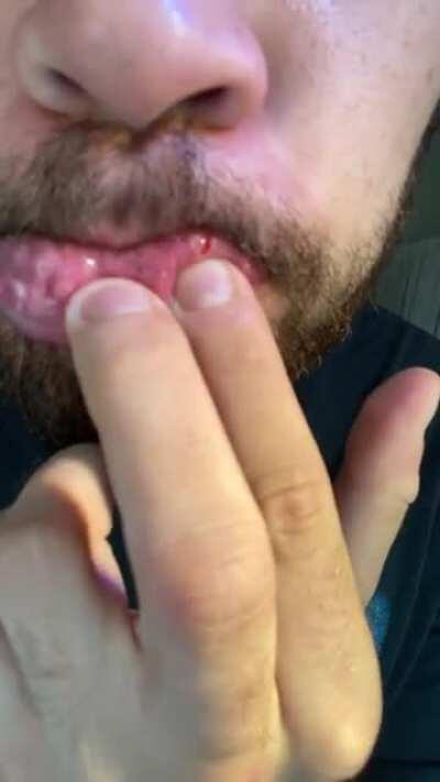 Mouth Pimple