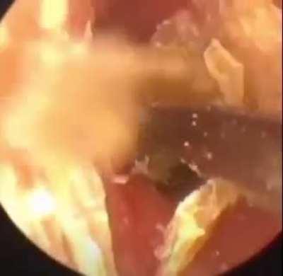 Earwax removal