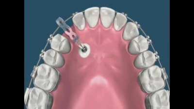 Sometimes a teeth does not erupt from the jaw, so the Orthodontist has to pull it out with a bracer over the course of several months.