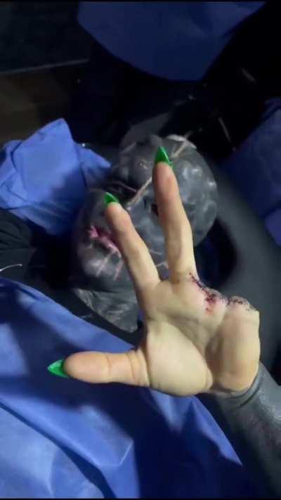 French body modification enthusiast Anthony Loffredo aka Black Alien Project just had two healthy fingers amputated... he also took off part of his nose and his ears to look like an Alien.