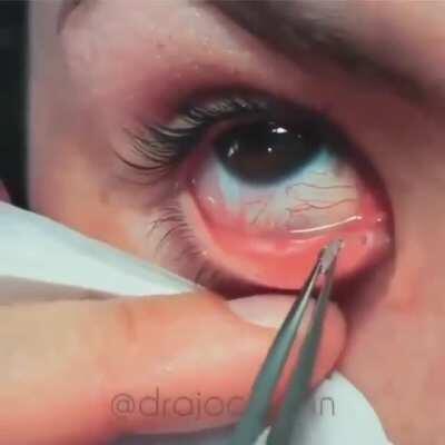 A simple one: eye stent removal