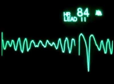 Cardiac Arrest graph during last moment