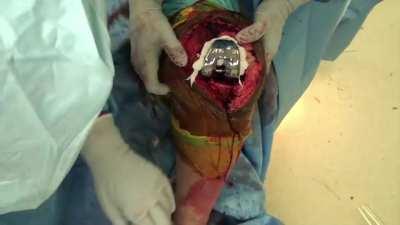 Total Knee Replacement