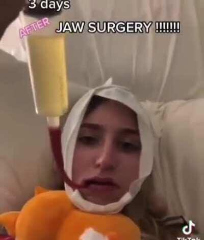 Jaw surgery completely changes girl's face