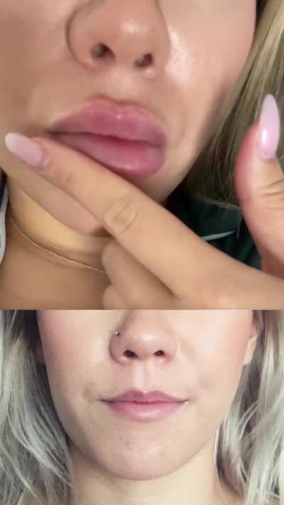 Lip filler progress over several years - 4ml or 5ml - should I get more or stop here? 