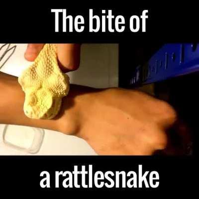 The Bite of a rattlesnake