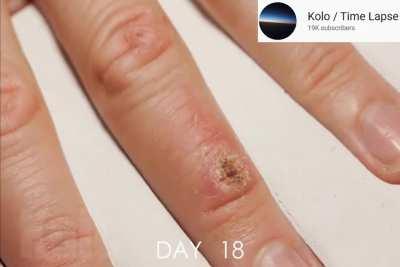 a time lapse of the body's natural healing process