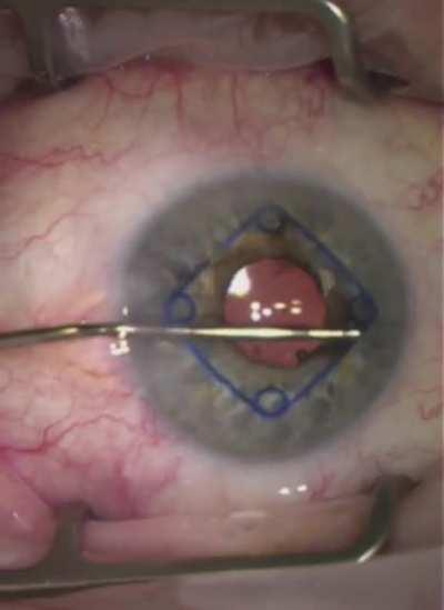 Removing a pupil stretching ring from the eye