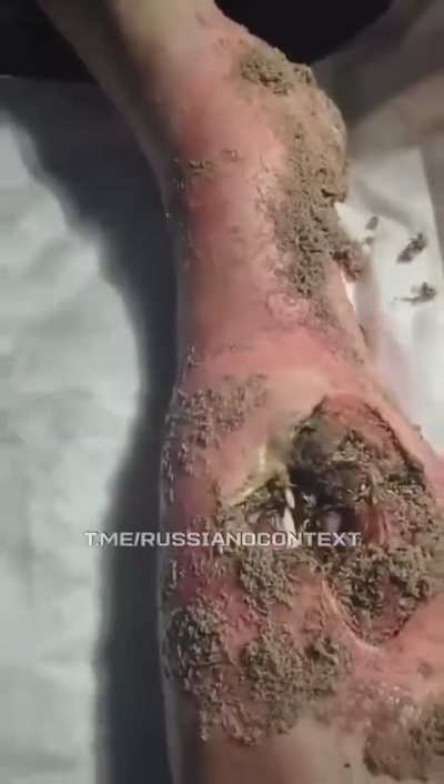 Wound of ru soldier infested with maggots