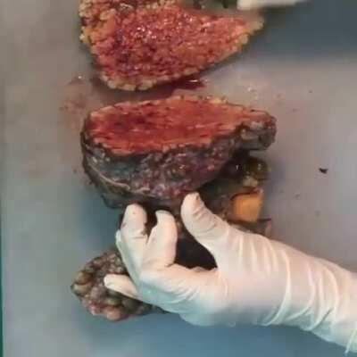 This is how the liver looks in the final stages of alcohol liver disease - cirrhosis.