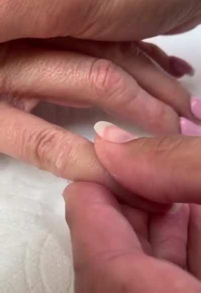 Applying prosthetic finger tip with water.