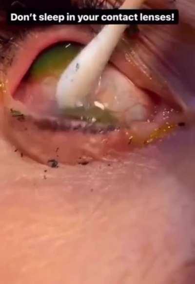 Woman slept with her contacts in, and never took out the old ones.