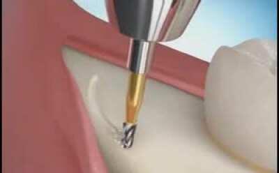 How a wisdom tooth is removed