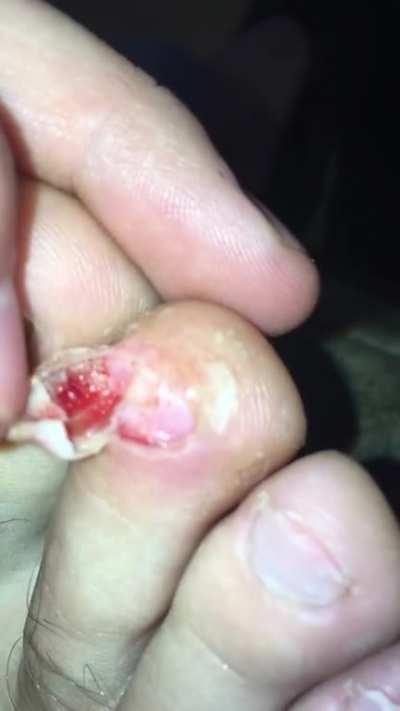 My case of runner’s toe...