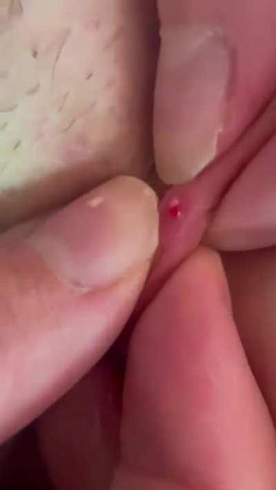 Gnarly ingrown hair pop with macro lense. Hair fully pops out.