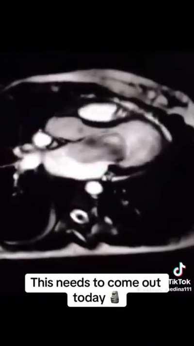 LA Myxoma inside the heart, beating on the mitral valve (requires surgery) 