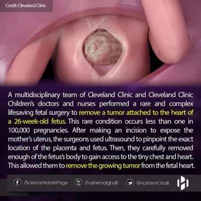 Doctors managed to remove a growing tumor attached to the heart of a 26 week fetus.