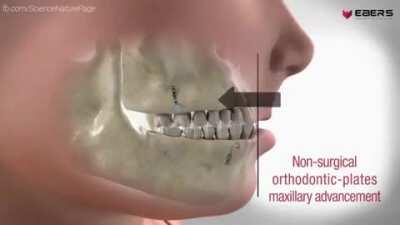 Ever had any kind jaw deformity? Here's how different types of jaw surgery is carried out!