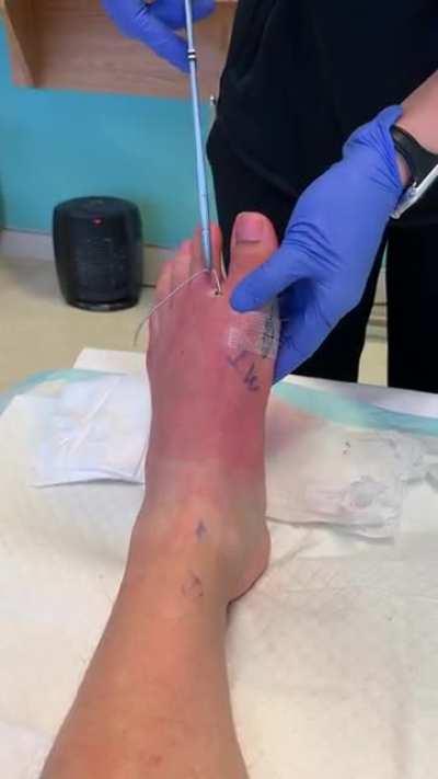 Pulling a pin out of my foot post surgery. (Bunion surgery)