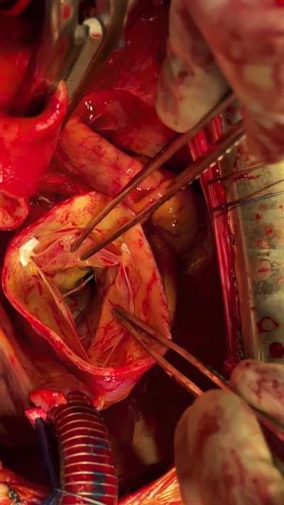 A quick tour around aortic root during aneurysm repair