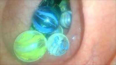 Some marbles inside my intestines (endoscope)