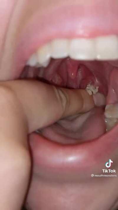 Yum mouthpimple