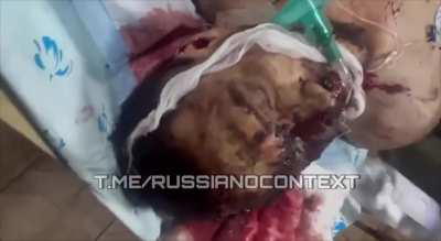 Russian soldiers brains blown out in some hospital in bakhmut region 