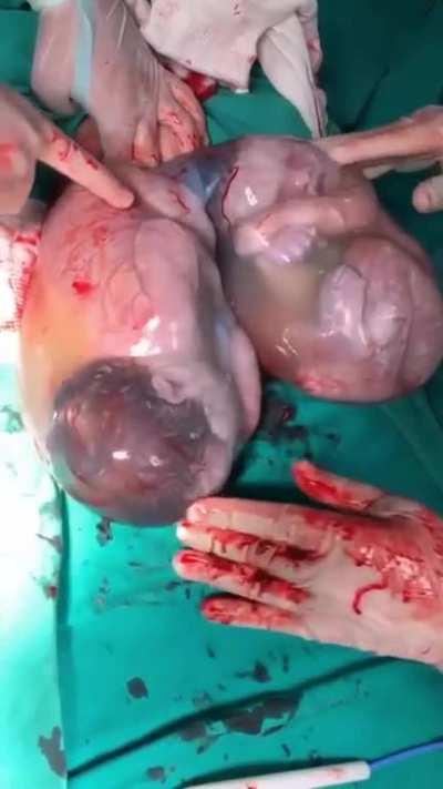 This is the amazing moment newborn twins were born still inside their amniotic sacs! Fewer than one in 80,000 babies are born ‘en caul’