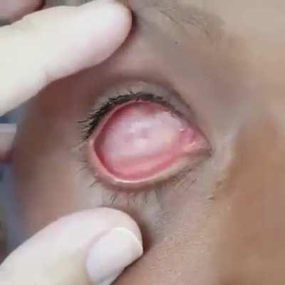 Surgical Eye Removal - Enucleation or Evisceration