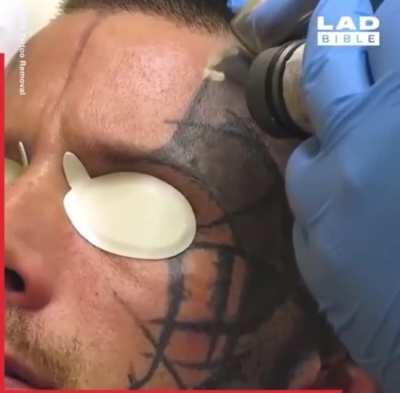 Laser tattoo removal