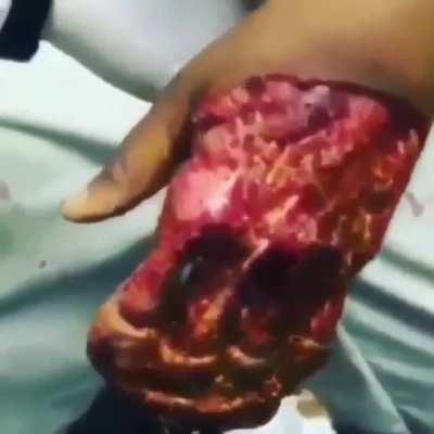 Hand Trauma. Degloving injury