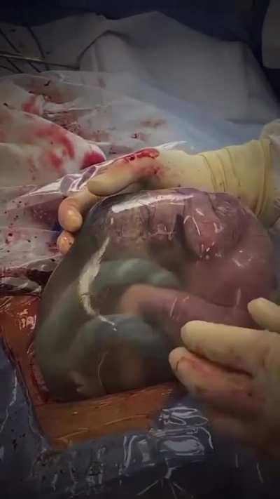 En caul deliveries are defined as a fetus that is delivered completely contained within an amniotic sac and are considered to be less common than 1 in 80,000 live births