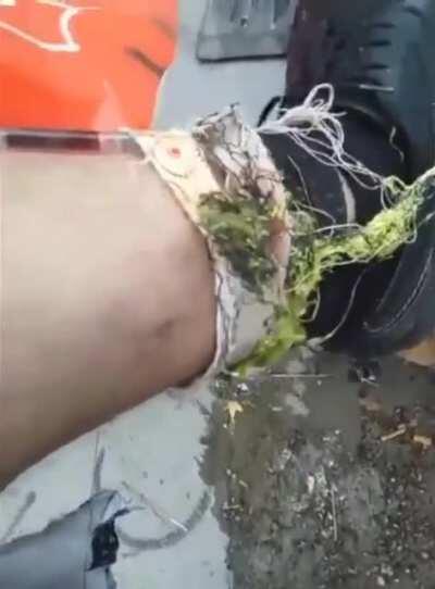 Guy shows off the plant he has growing out of the abcess on his leg