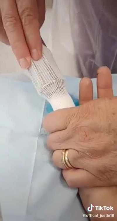 Tool used to wrap a finger after a burn or injury.