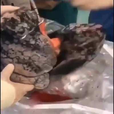 In this video, we are looking at the blackened lungs of a 52-year-old man who smoked about 1 pack a day for ~ 30 years. The patient had signed up to donate his organs after death, but doctors quickly realized that they would not be able to use them. We ca