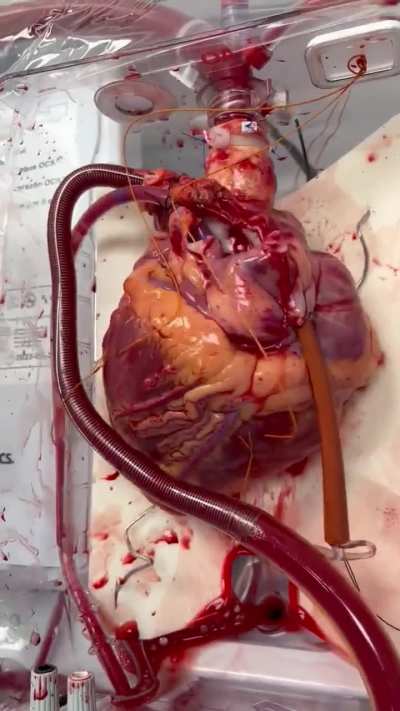 A human heart awaiting transplant. Crazy to think this is how it beats inside our body normally, 24/7