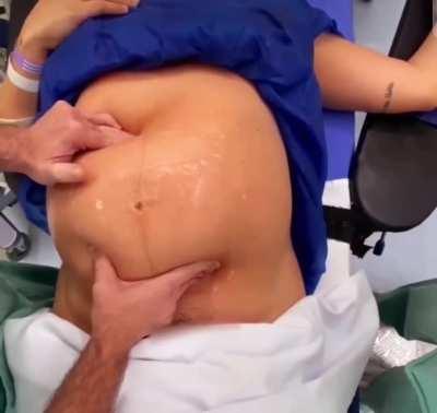 Doctor turns baby inside belly to avoid cesarean