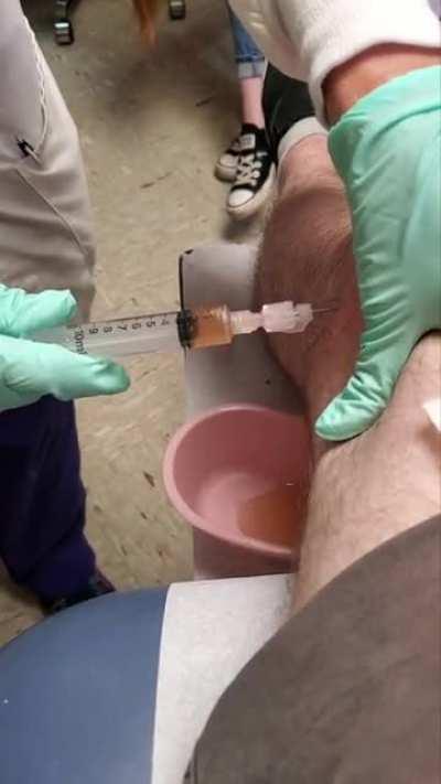 Had to have my knee drained of inflammatory fluid. Over 90 ml from just one side. Thought I would share the process!