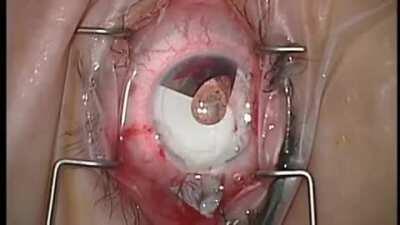 Removing a cosmetic iris implant.