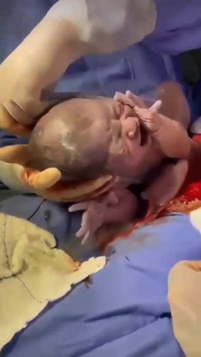 Newborn baby born in an intact amniotic sac