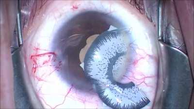 Prosthetic Cosmetic iris implants are a novel way to change eye color but they often need to be explanted because unfortunately, they cause a UGH (Uveitis Glaucoma Hyphema) syndrome. (Technique described in comments)