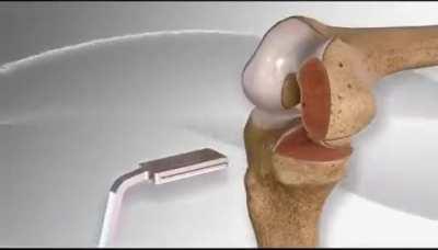 This is how a partial knee replacement is done