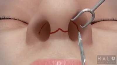 This nose job video