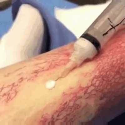 This satisfying thing is called sclerotherapy. Sclerotherapy is a medical procedure used to eliminate varicose and spider veins. Doctors usually inject a sclerosant into the vessels causing them to collapse and involute. This causes them to disappear imme