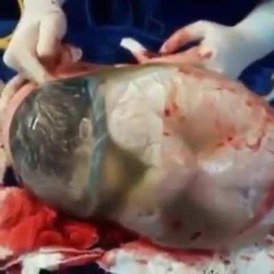 Here a Baby born perfectly healthy still in the amniotic sac. This happens only 1-80,000 births.