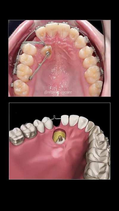 Pulling a teeth from underneath with braces.