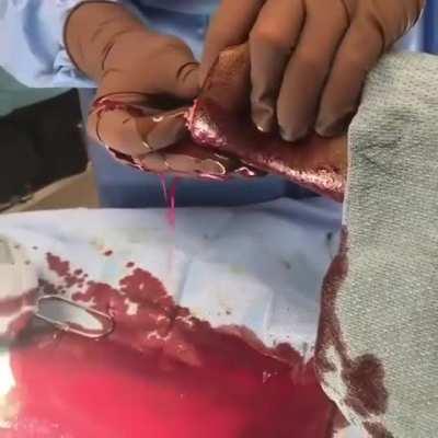 Wire saw amputation of severe foot infection. Warning, sensitive content!!!