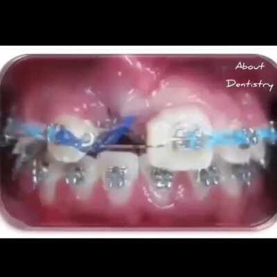 Orthodontic treatment timelapse