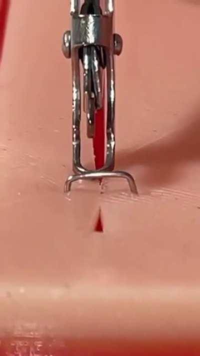 How medical staples are removed