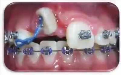 A time lapse of braces straightening teeth